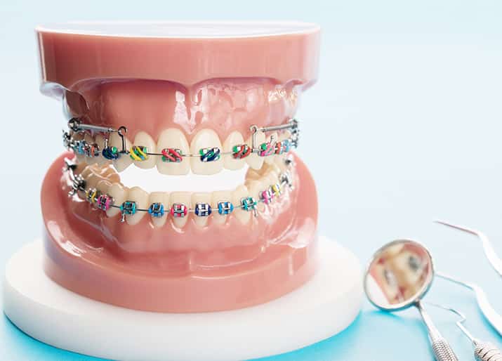 Ceramic Braces - Orthodontic Specialists of Melbourne